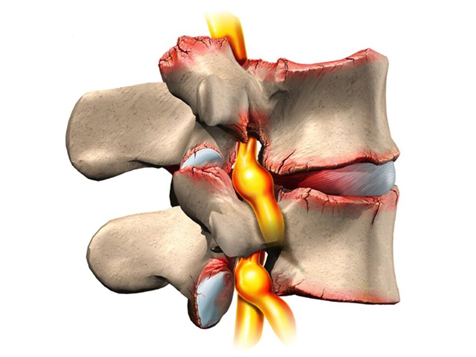 vertebral injury with osteochondrosis