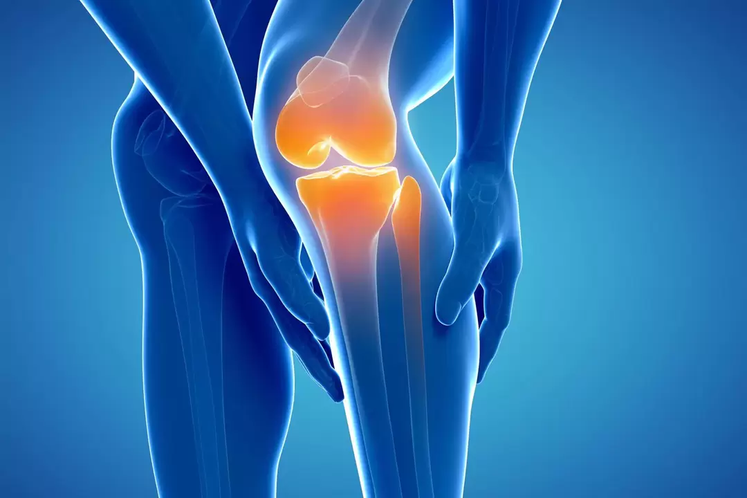 Arthropathy of the knee joint (knee joint, osteoarthritis deforming)