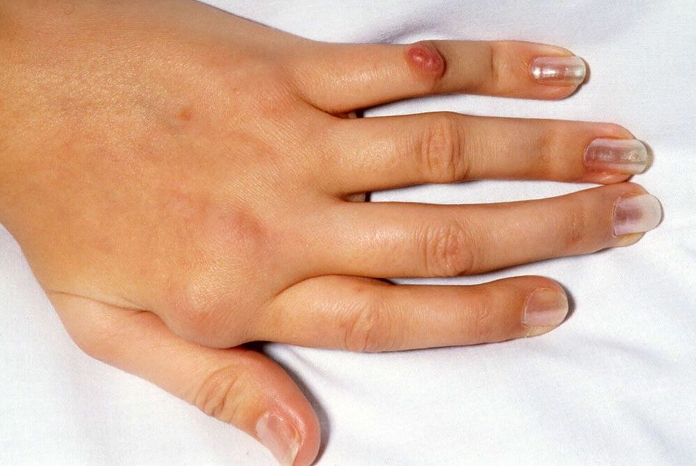 deformity of the joint due to rhizarthrosis
