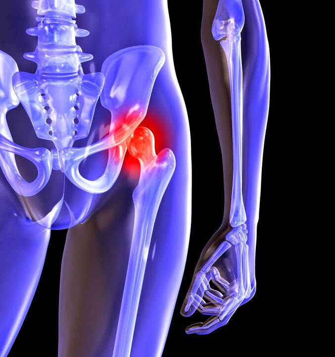 Distorting arthritis of hip joint