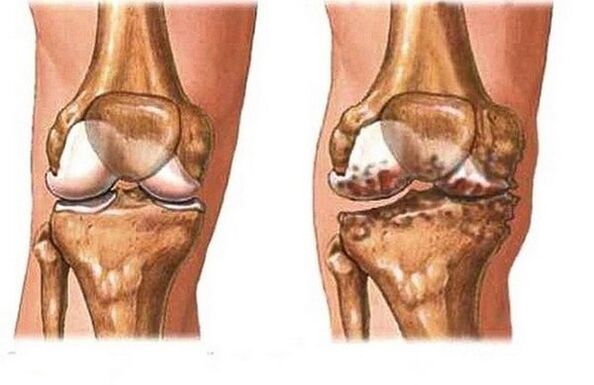 Healthy and painful joint