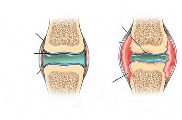 The process of deformation of the joint