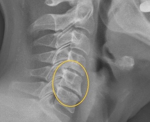 Cervical spine osteochondria