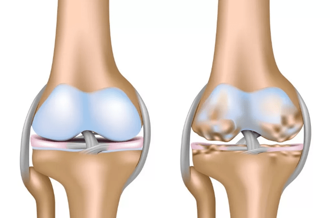 Deformative arthritis of the knee joint