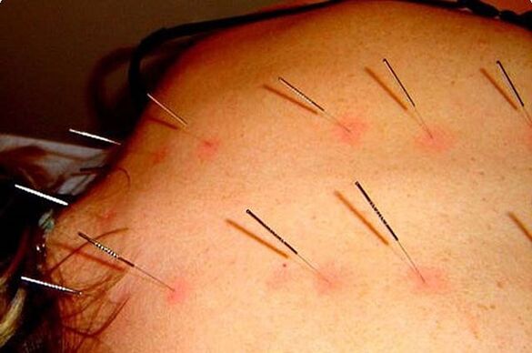 Acupuncture - a method of treatment of cervical osteochondrosis
