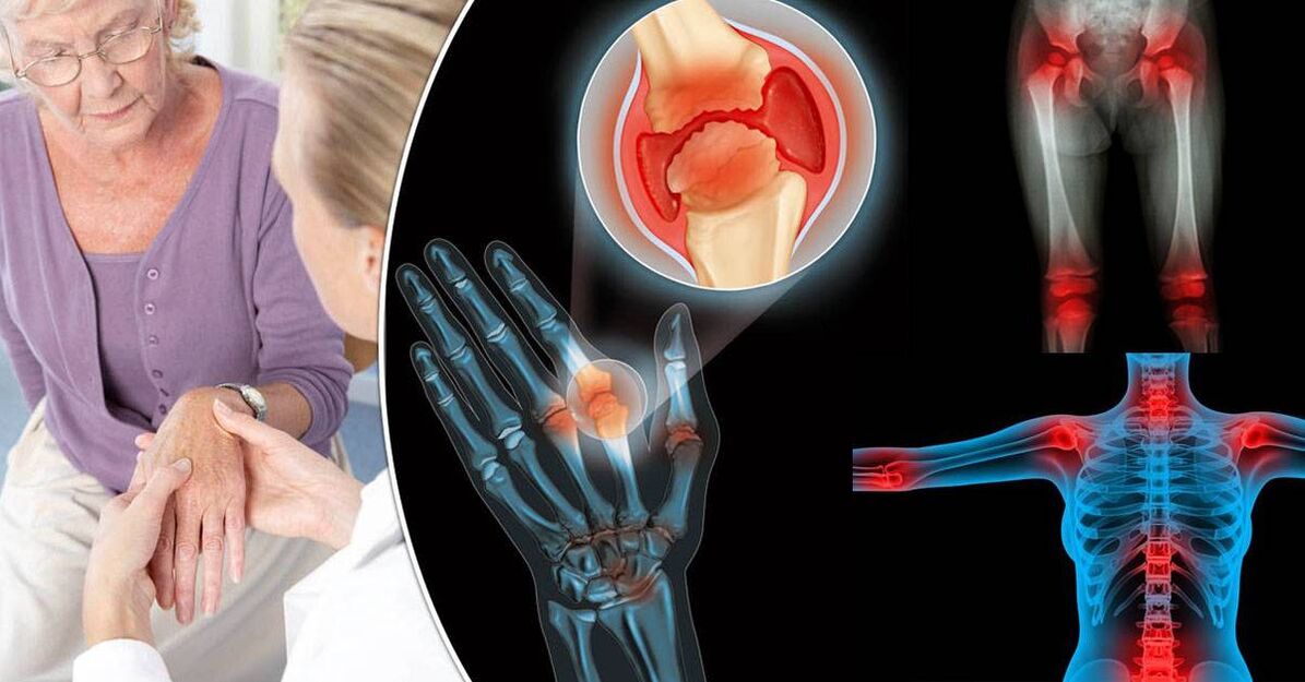 what is arthritis